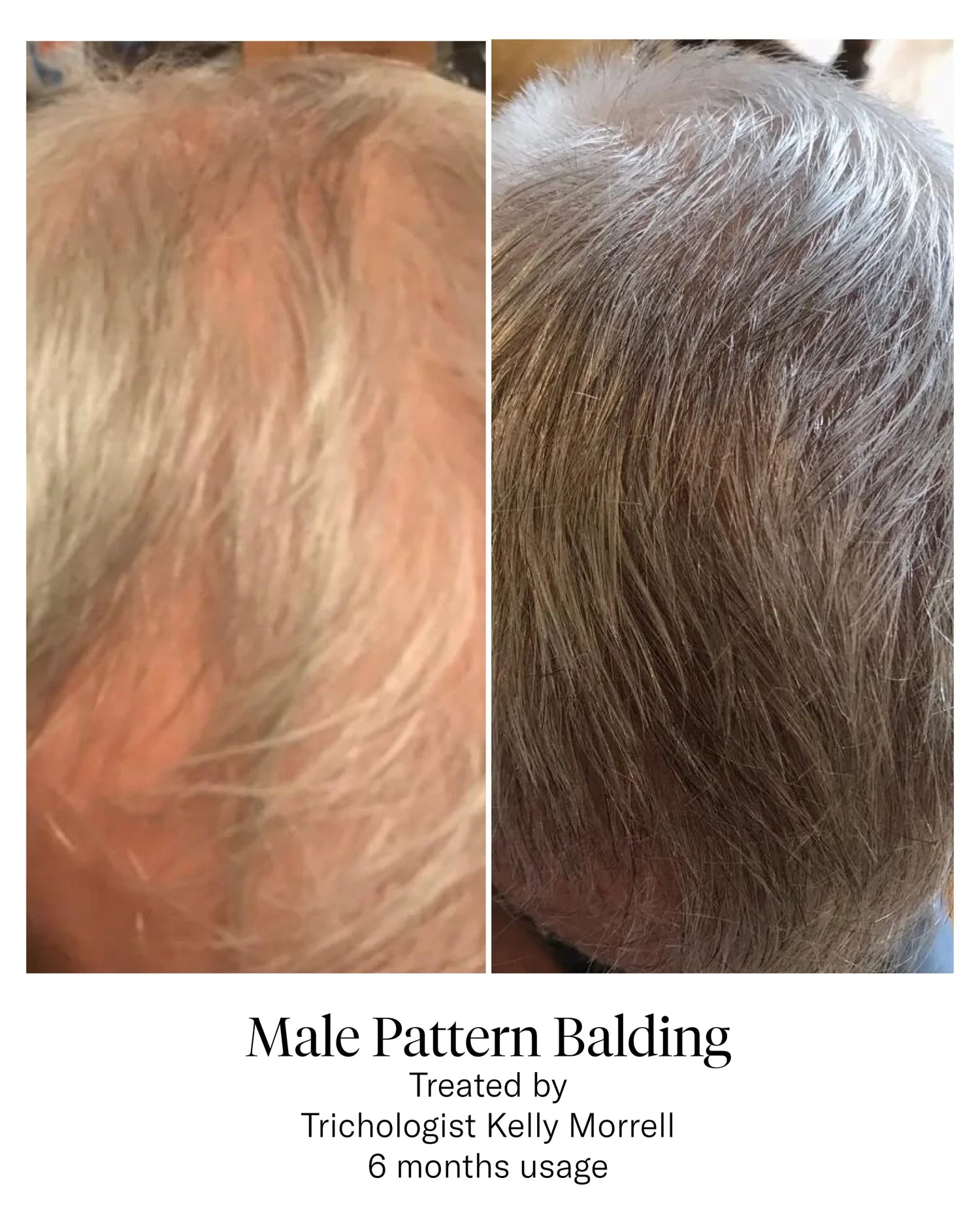 Calecim Advanced Hair System