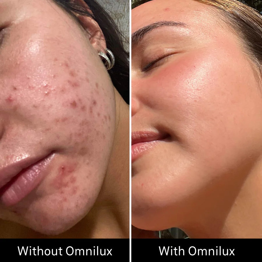 before and after results Omnilux Clear