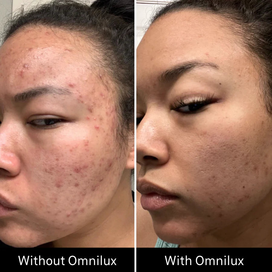 before and after results Omnilux Clear