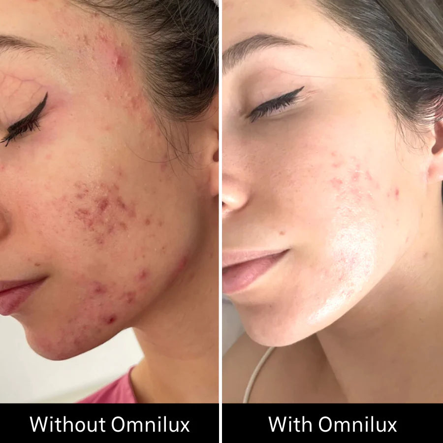 before and after results Omnilux Clear