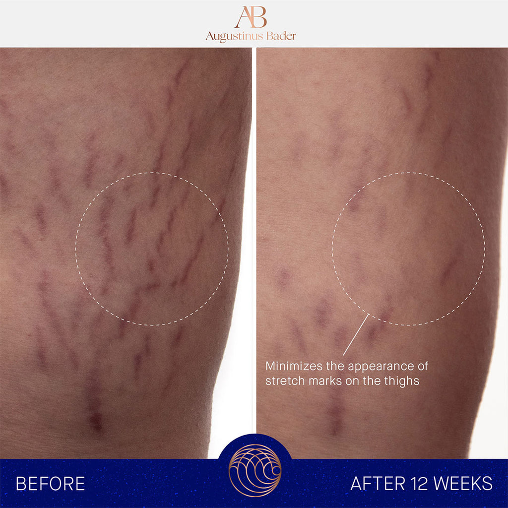 before and after results augustinus bader the body cream on thighs