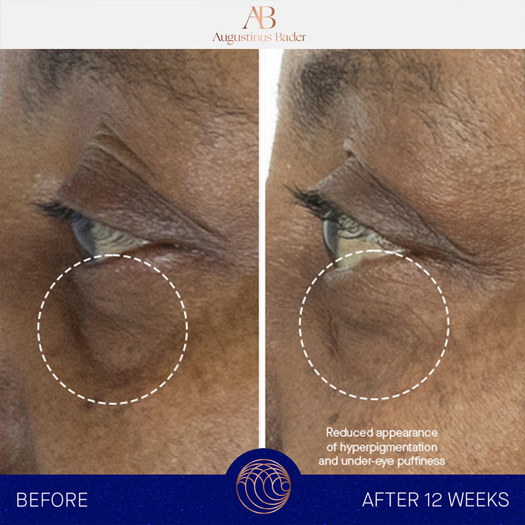 augustinus bader the eye cream bottle before and after under eye results