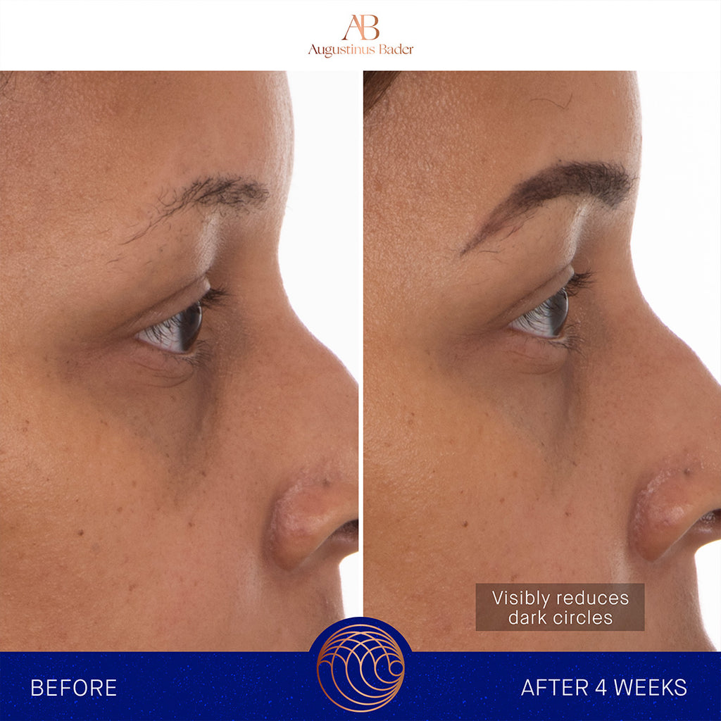 augustinus bader eye patches before and after under eye