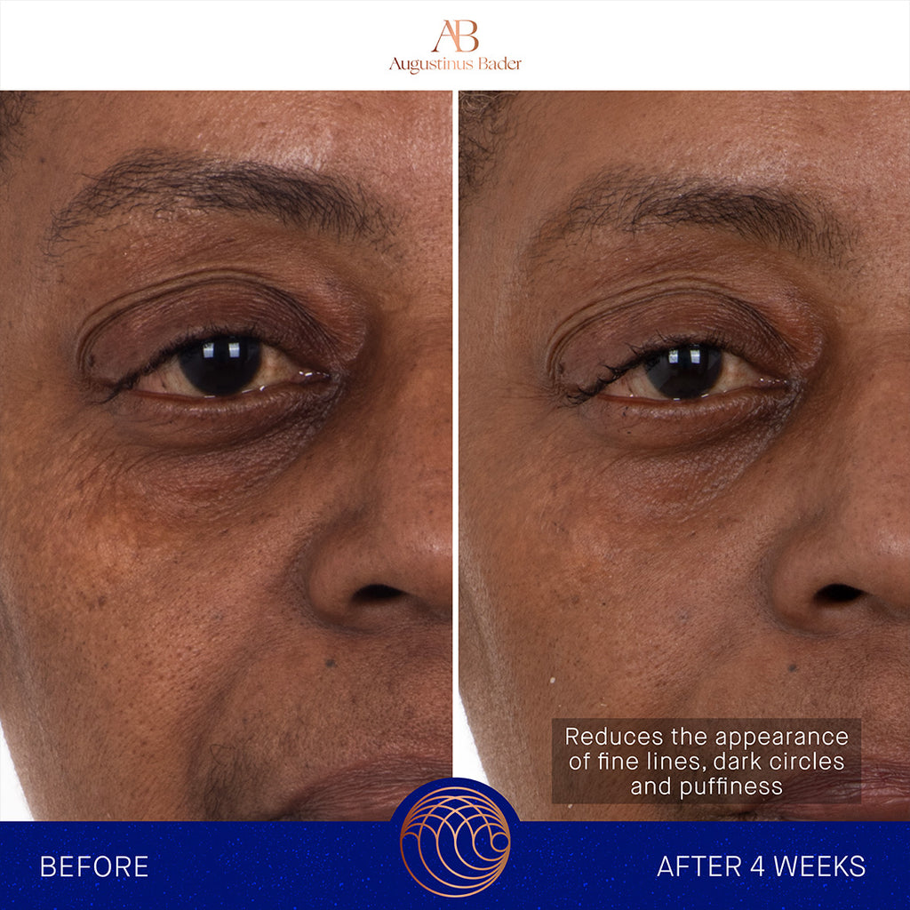 augustinus bader eye patches before and after under eye front view