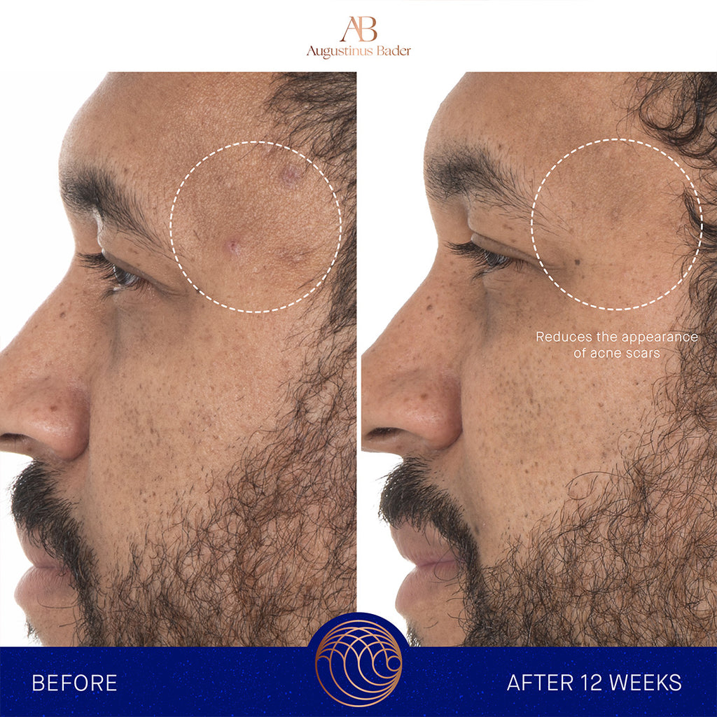 augustinus bader the retinol serum before and after results