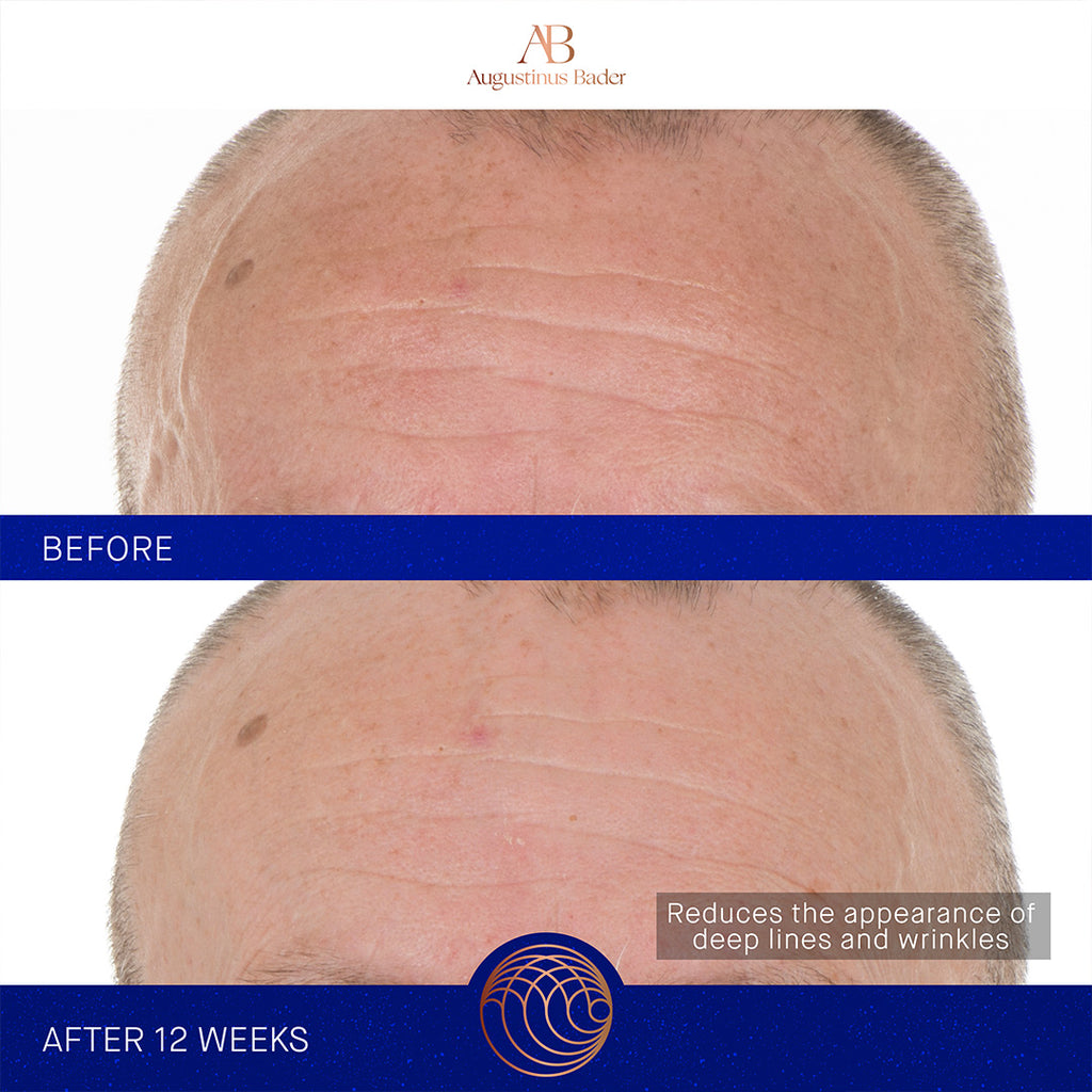 augustinus bader the retinol serum before and after forehead close up