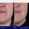 augustinus bader the rich cream before and after results of chin