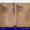 augustinus bader the serum complete set before and after results face