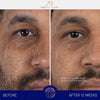 augustinus bader the serum complete set before and after results man's face